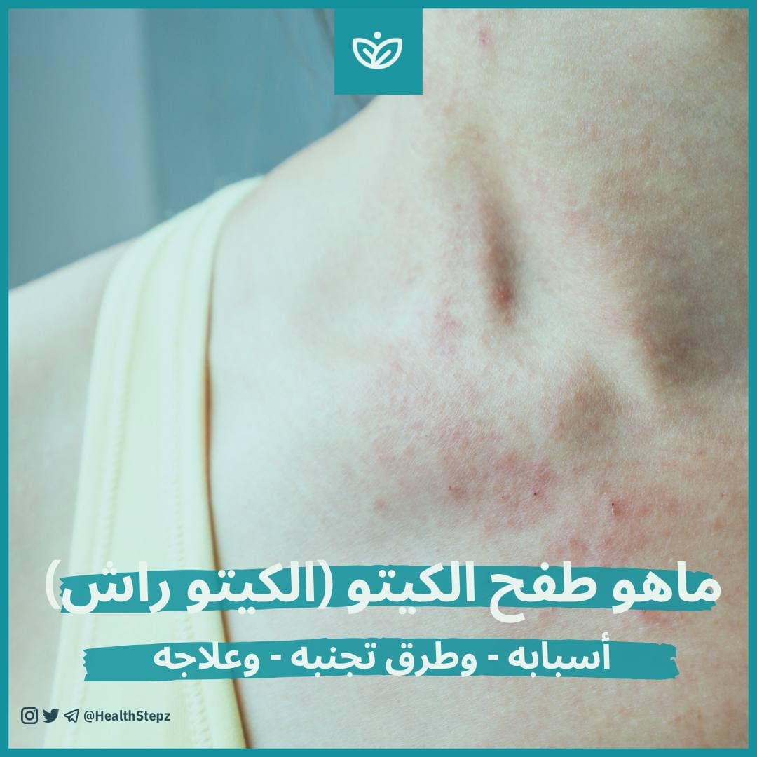 📛 ماهو طفح الكيتو (أو الكيتو راش - Keto Rash)؟